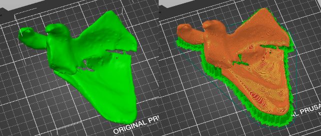Společnost pro 3D tisk v medicíně - operace lopatky za použití 3d tisku